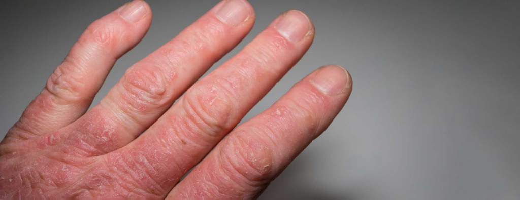 Signs of psoriatic arthritis