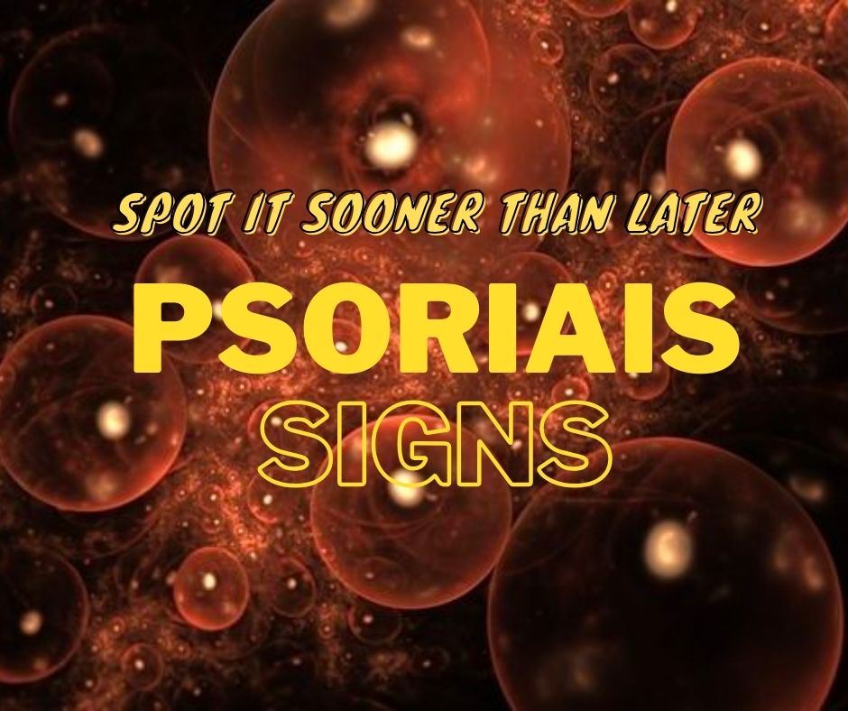 Psoriasis signs