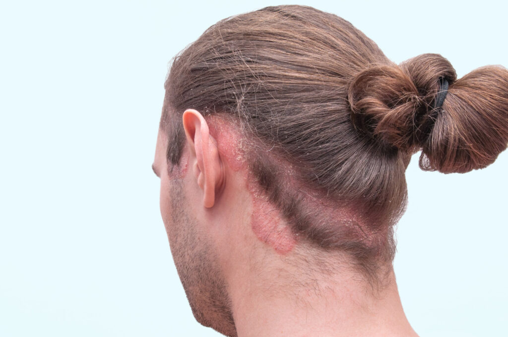 Scalp Psoriasis: Causes, Symptoms & Treatments