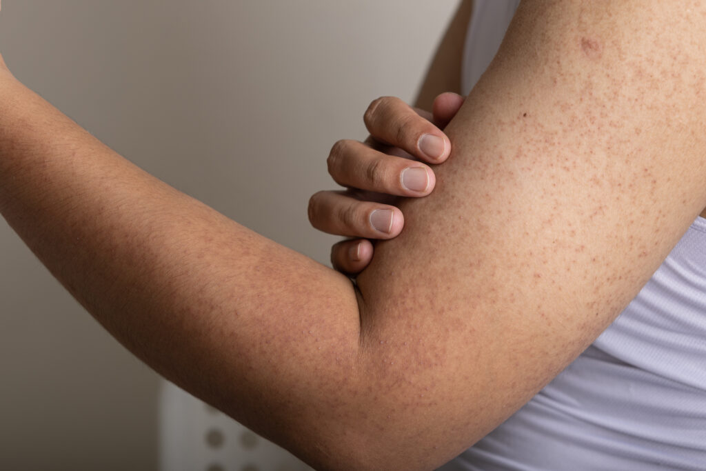 Keratosis Pilaris: What It Is, Causes, Symptoms & Treatment