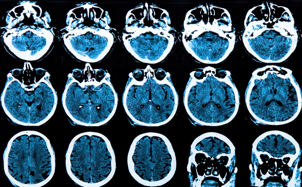 Signs and Symptoms of Huntington’s Disease