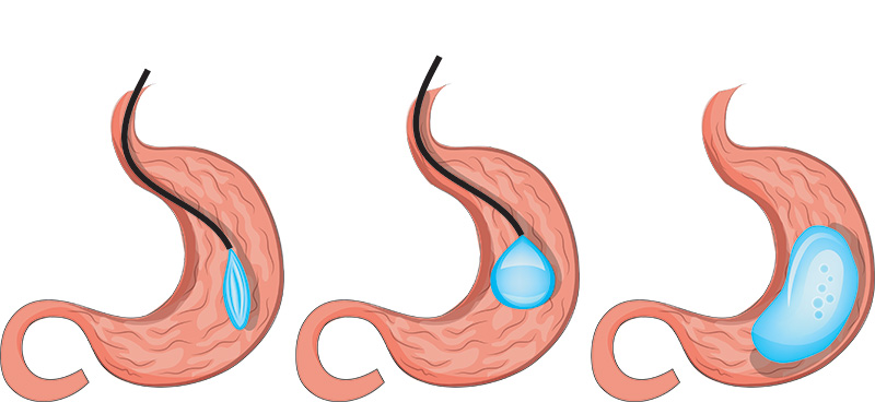 Getting a Gastric Balloon to Control Weight