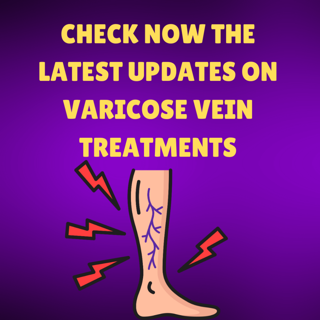 Varicose vein treatment